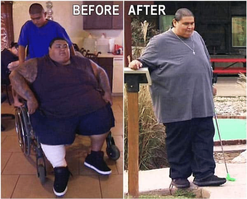 Before and after photo of male patient after using Dr. Nowzaradan's 1,200 Calorie Diet and having surgery.